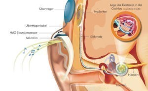 Hörimplantat Cochlea Implantat Funktion