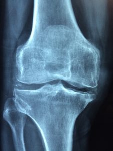 Die Ursachen von Schmerzen im Knie können Ärzte unter anderem auf dem Röntgenbild erkennen. 