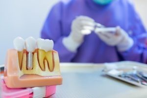 Zahnästhetik Bremen – Implantat